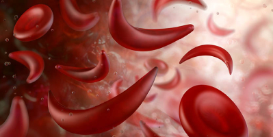 Sickle Cell Service Development within the East Midlands